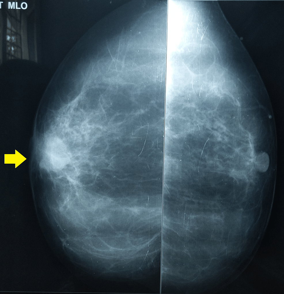 Cureus Primary Tubercular Breast Abscess in an Indian Female A Rare Case