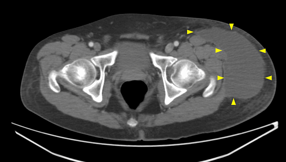 Cureus Outpatient Treatment of Refractory MorelLavallée Lesion