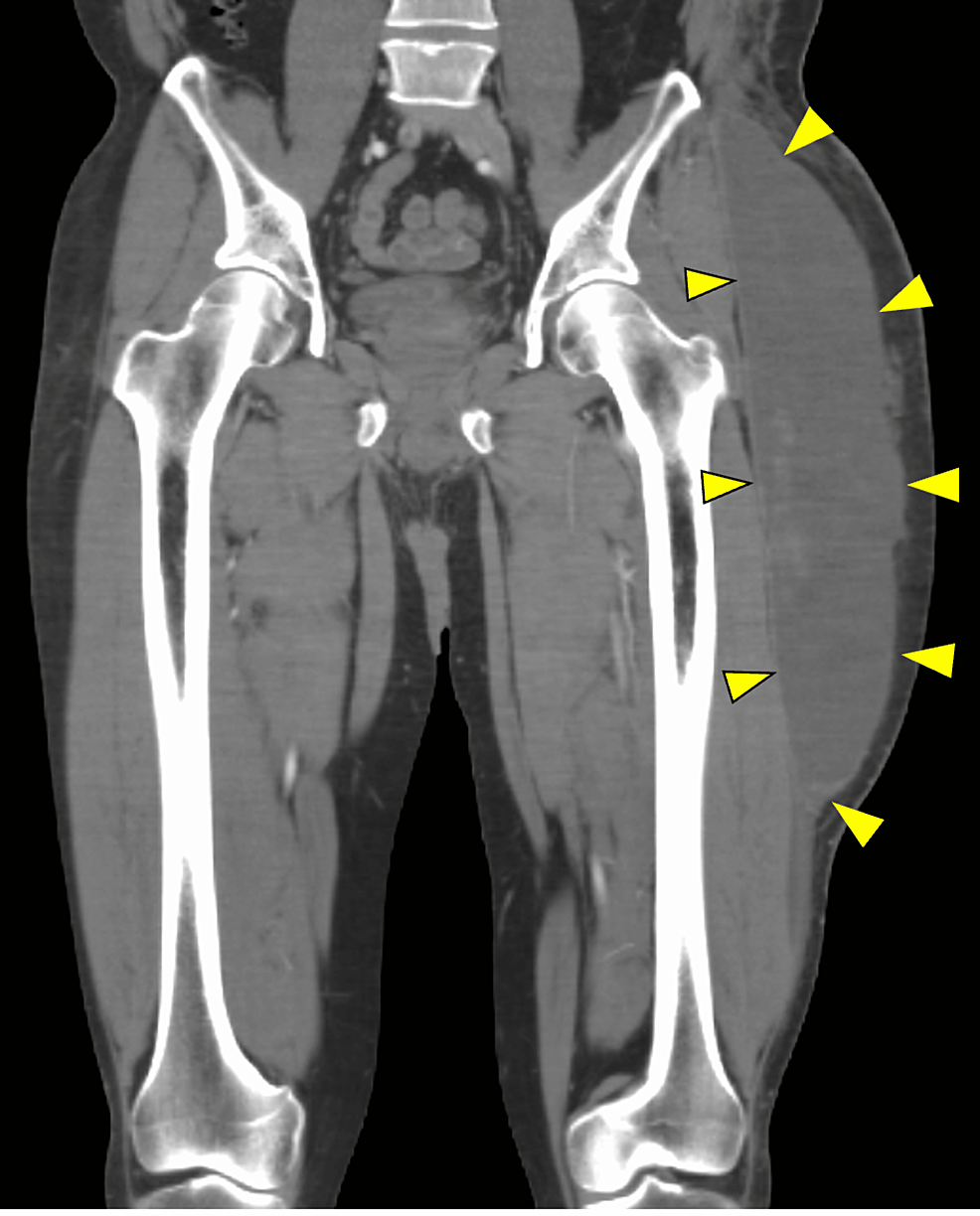 Outpatient Treatment of Refractory MorelLavallée Lesion Infection With