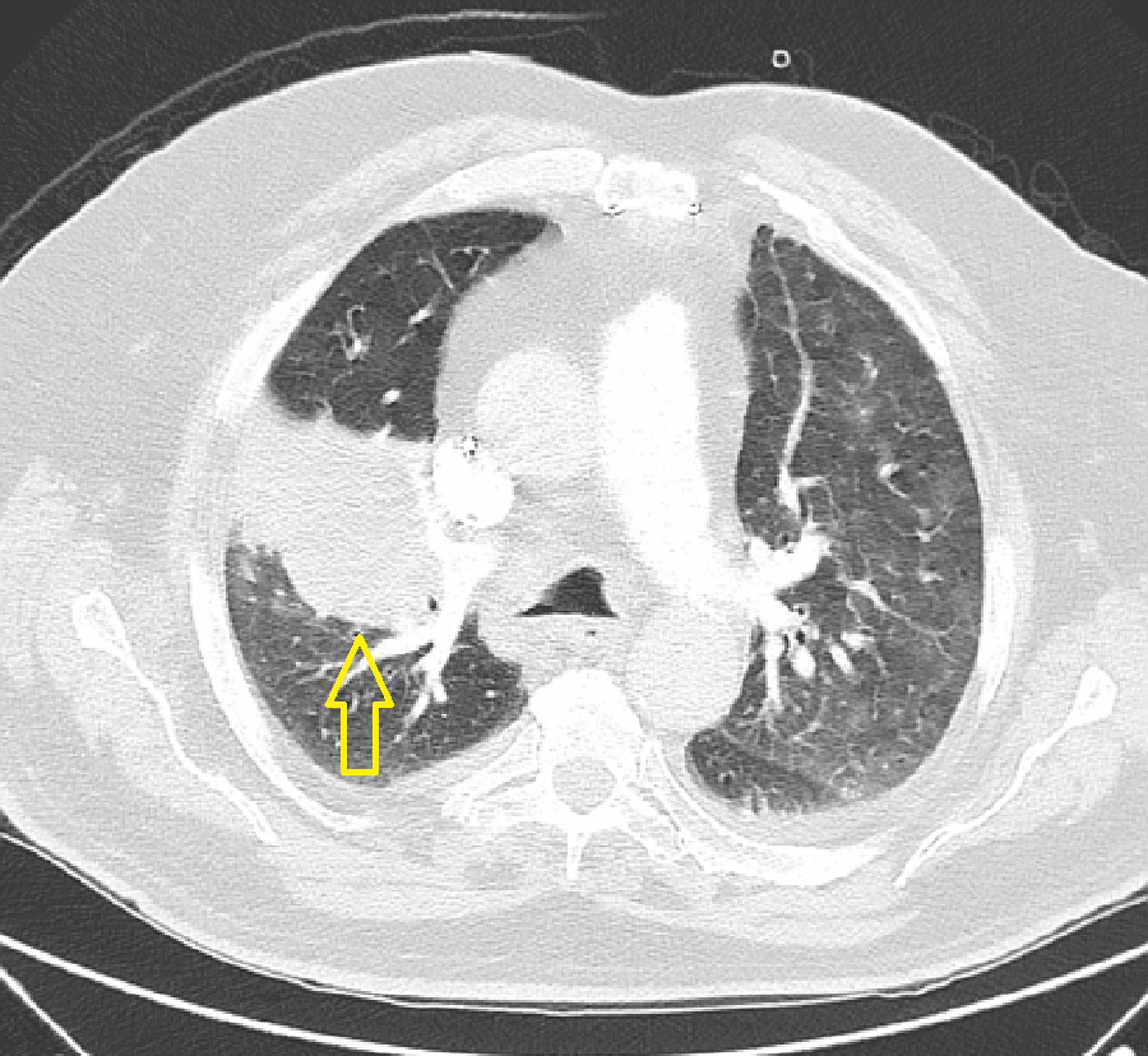 Cureus Pulmonary Spindle Cell Carcinoma A Rare Case Report