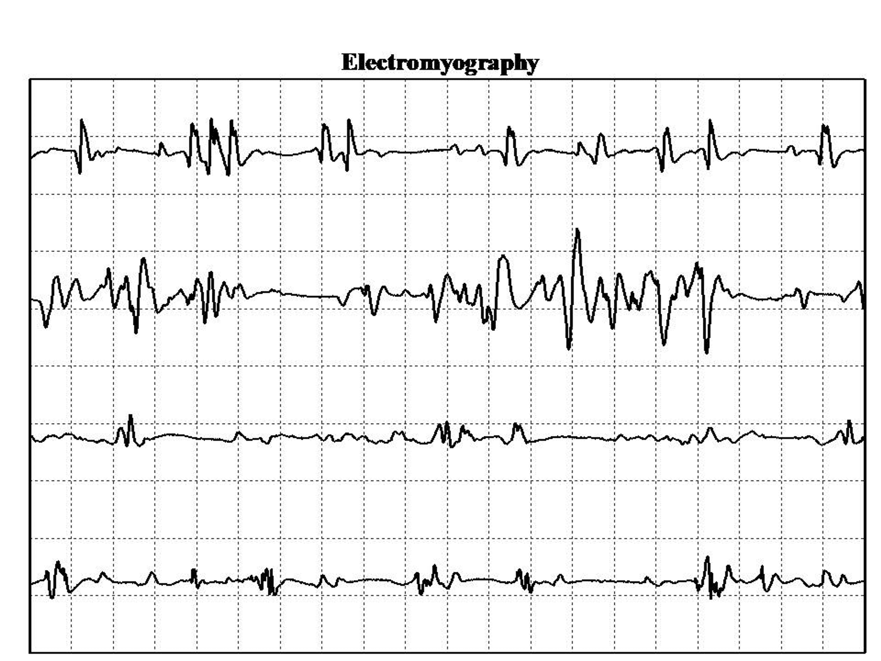 Cureus | Antisynthetase Syndrome: The Classical Phenotype With a Twist