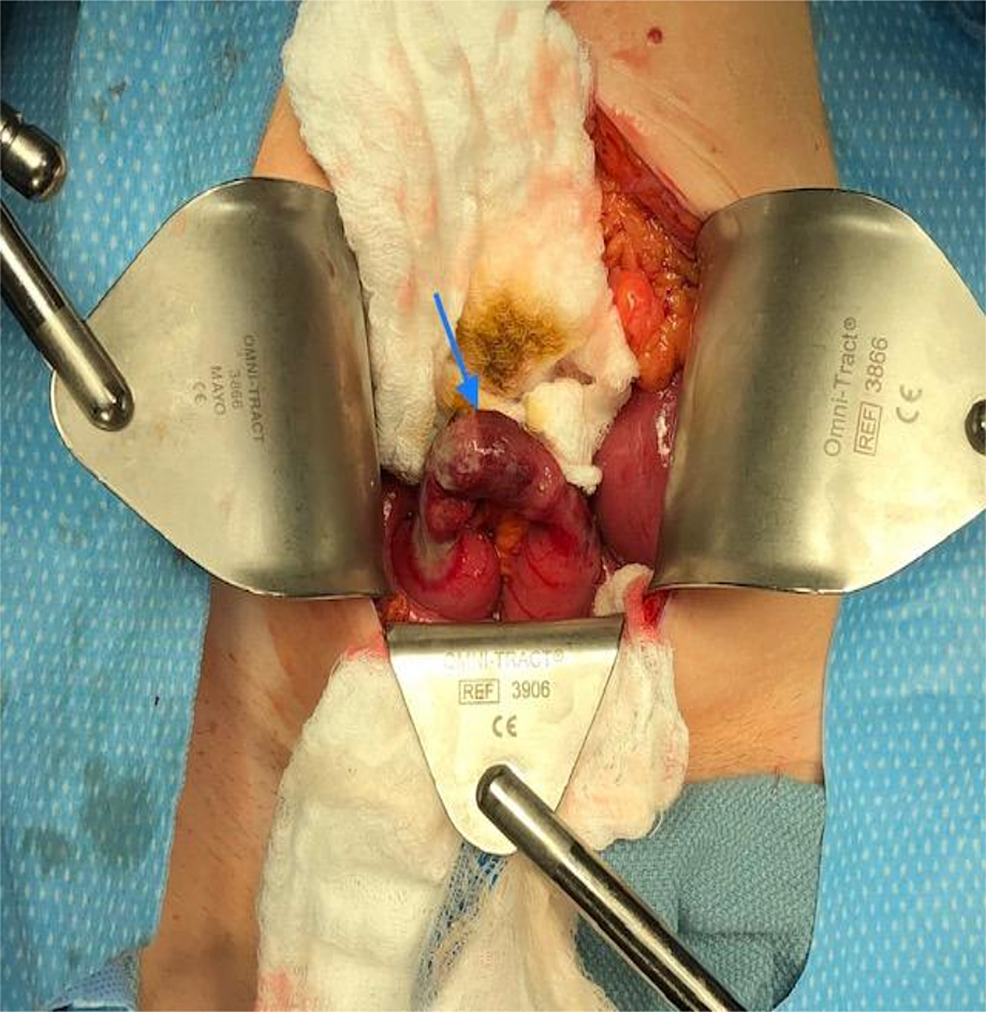 howship-romberg sign and bowel obstruction: a case report