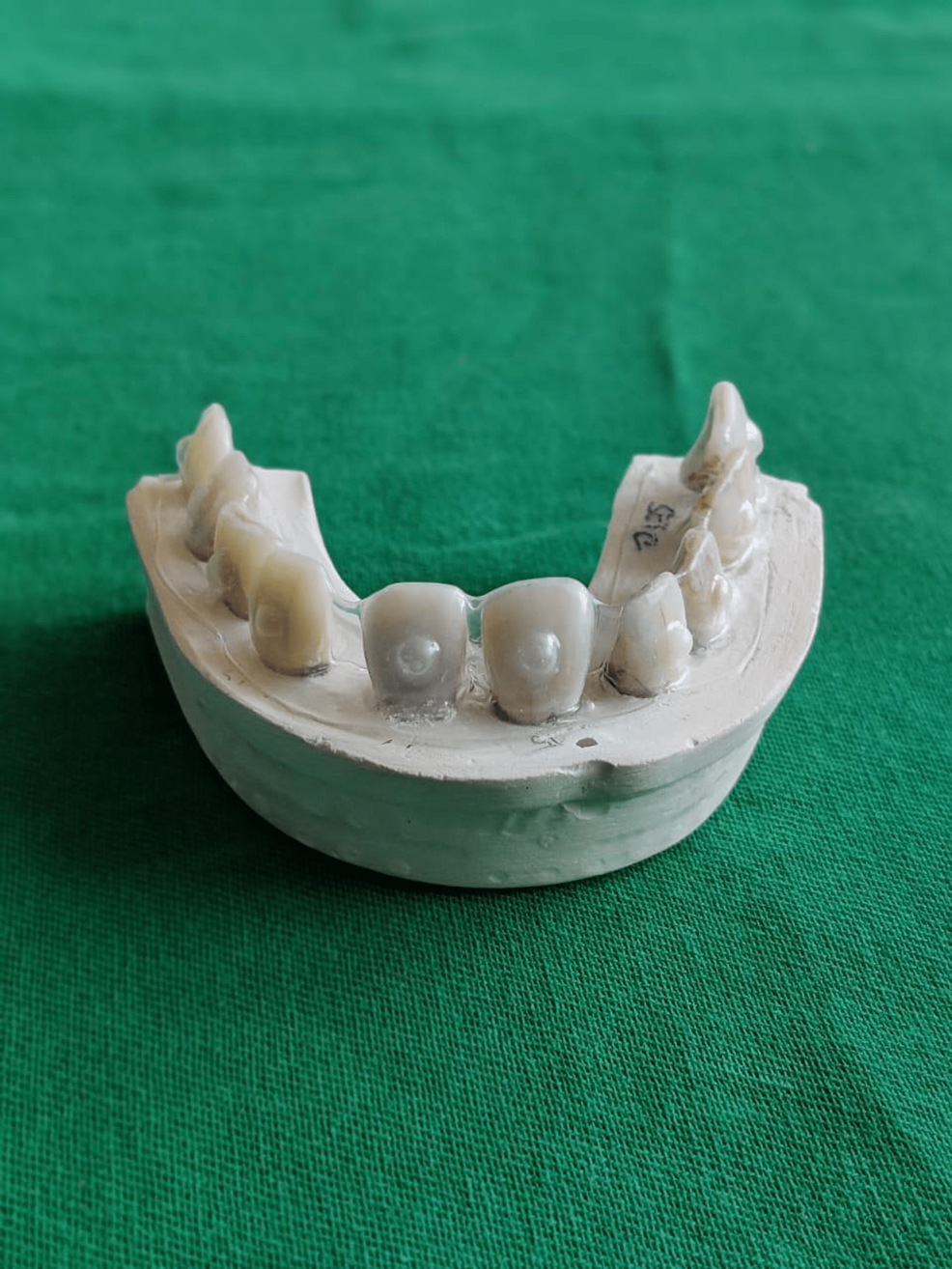 Cureus Efficacy of Tooth Bleaching With Prior Application of Two