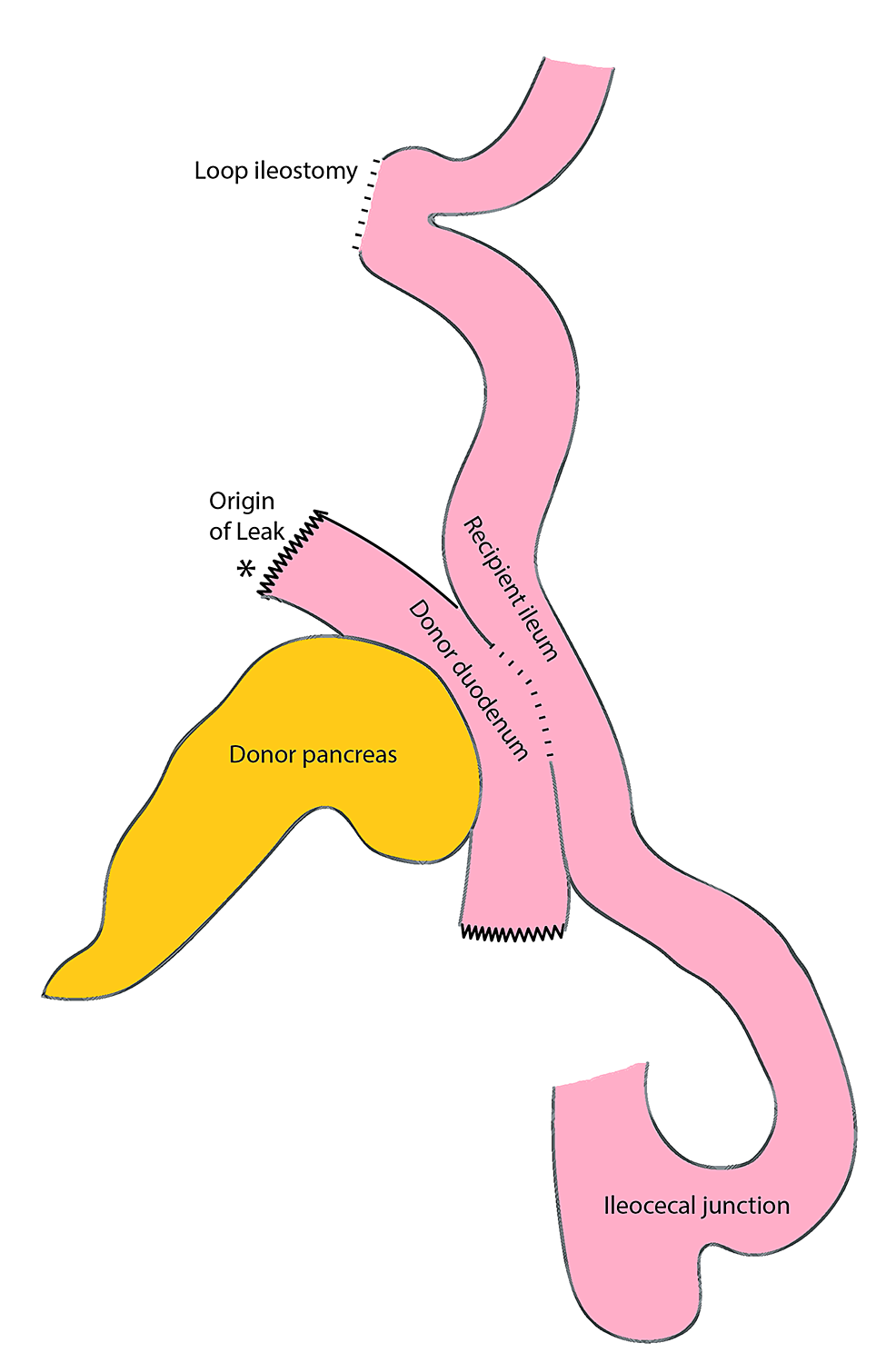 Loop Ileostomy Diagram 9231