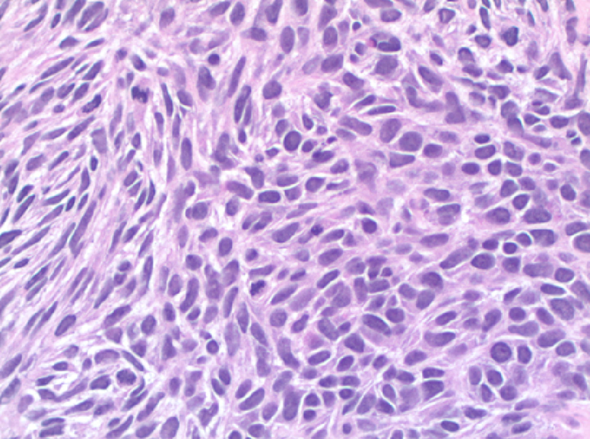 spindle cell sarcoma