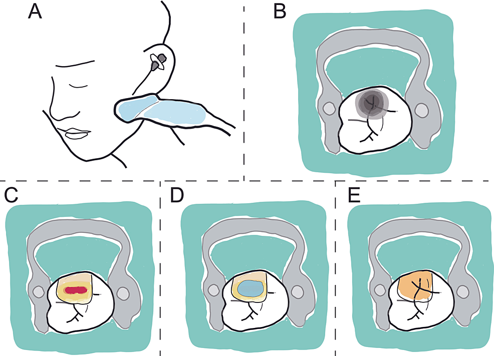 super-minimally-invasive-pulp-therapy-for-severe-pulpitis-a-report