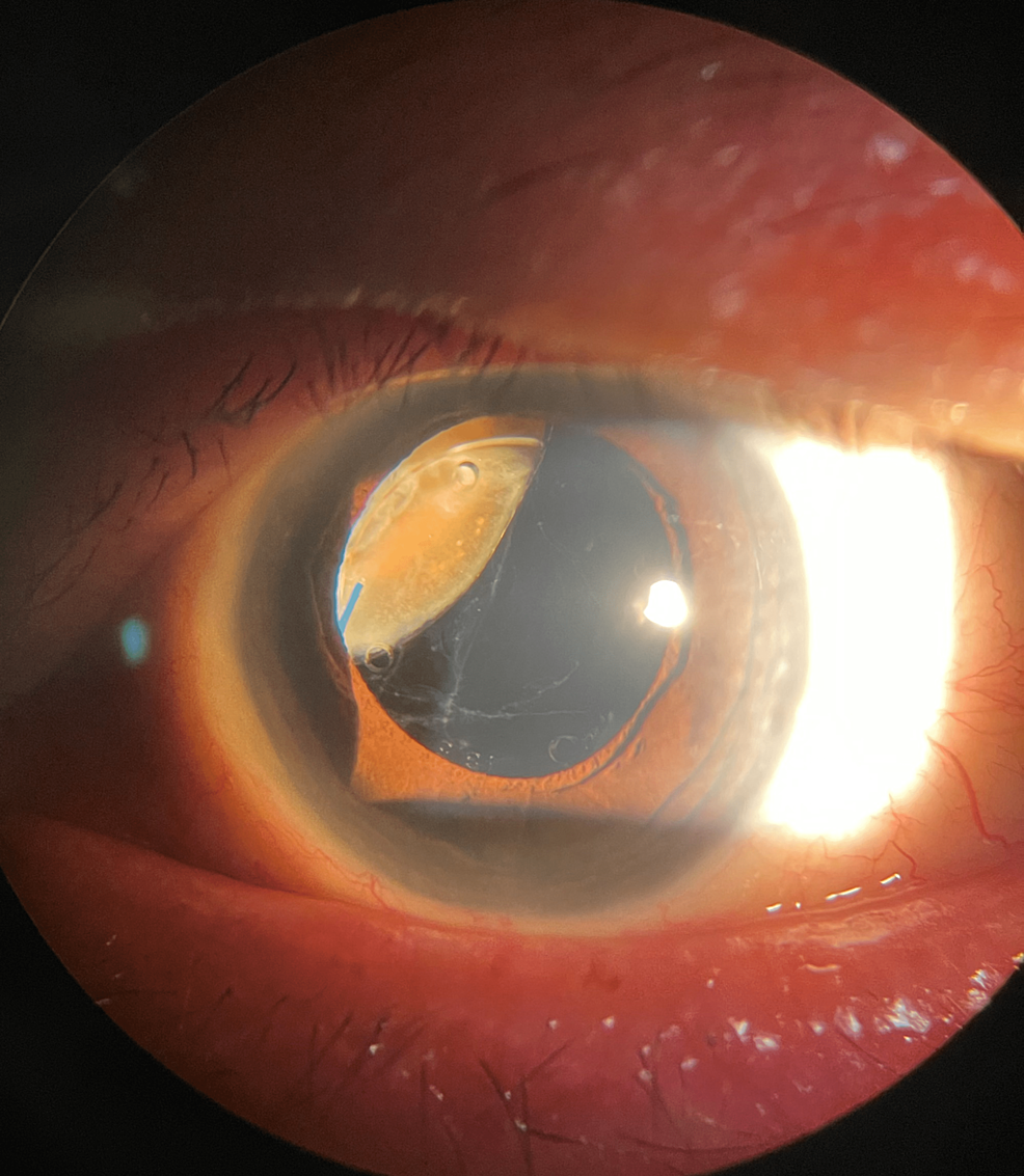 A Retained Lens Fragment Lying Dormant For Over 20 Years In The Eye ...