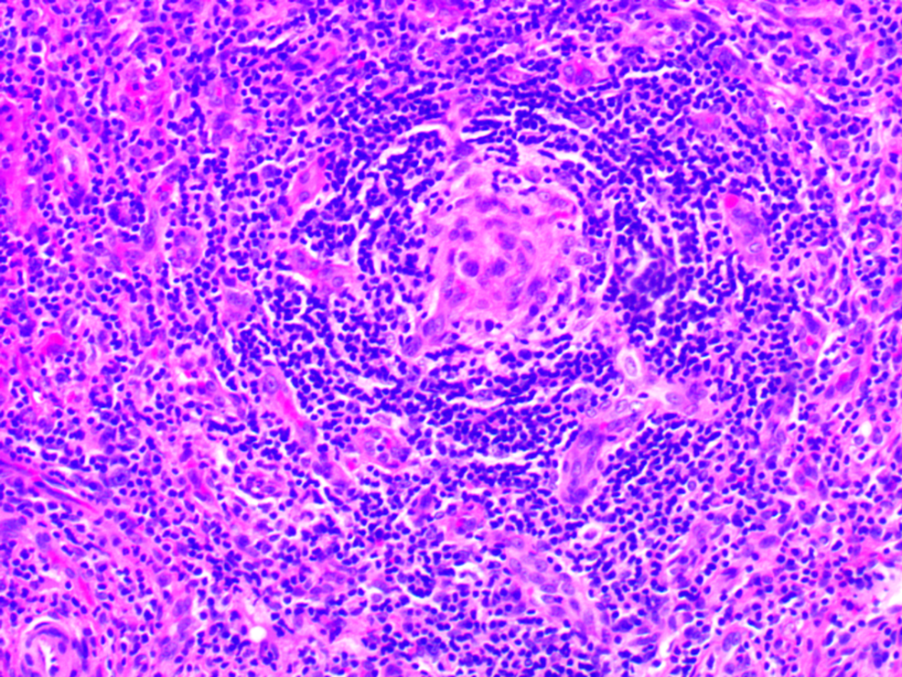 Cureus Tafro Syndrome A Case Of Significant Endocrinopathy In A Caucasian Patient