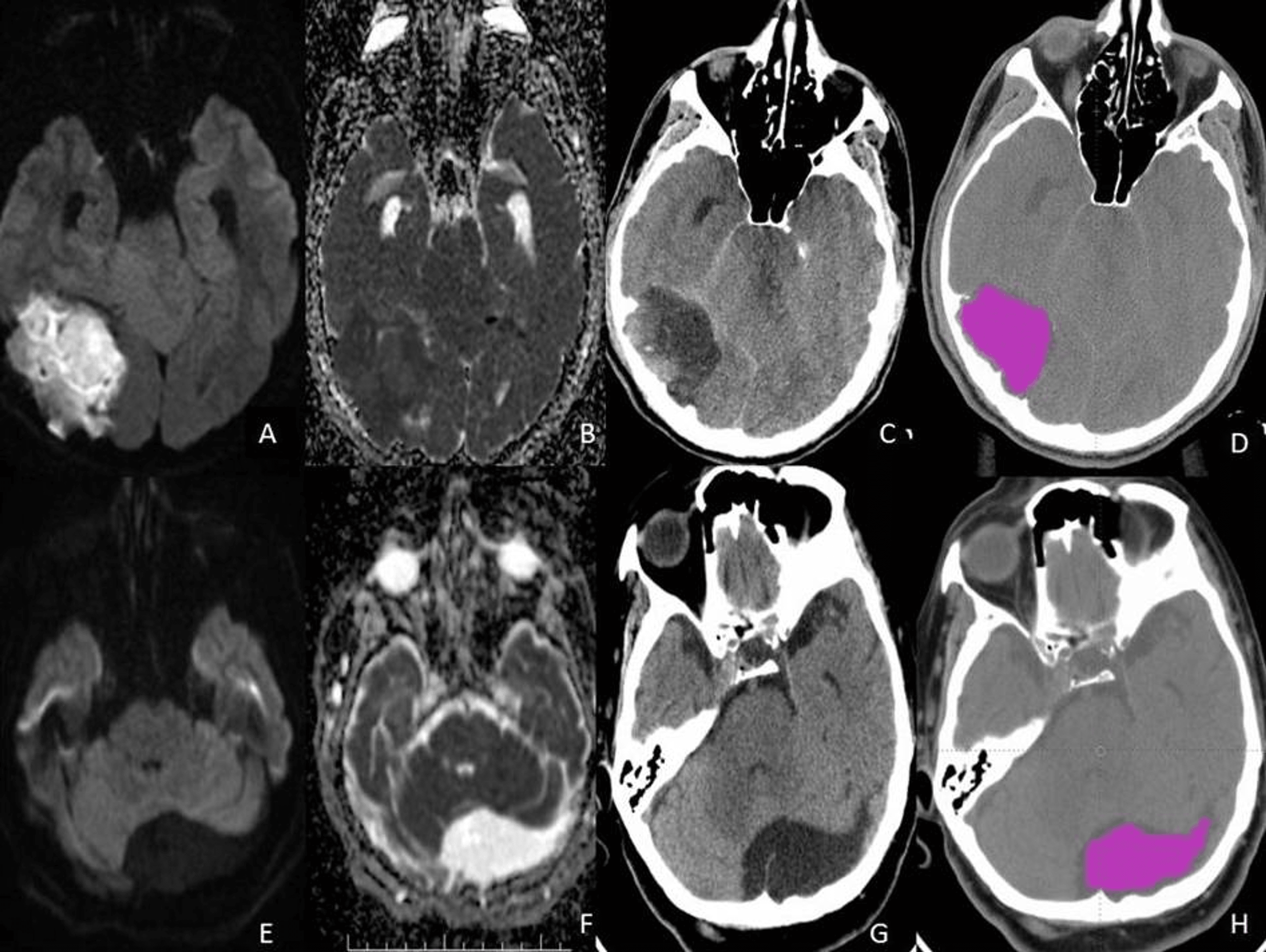 Computerized Tomography Texture Analysis In The Differential Diagnosis Of Intracranial 6584