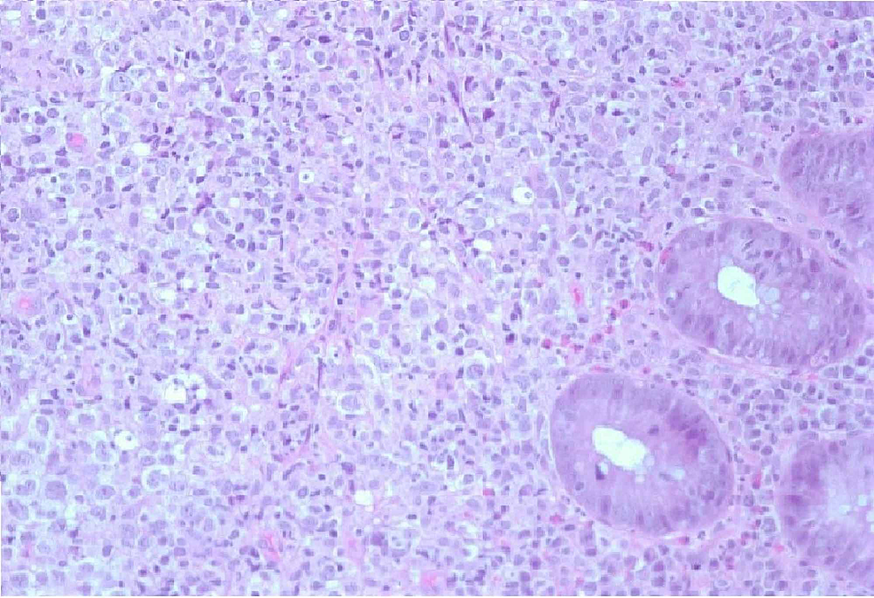 400-power-microscope-representing-our-patient's-primary-DLBCL-of-the-colon