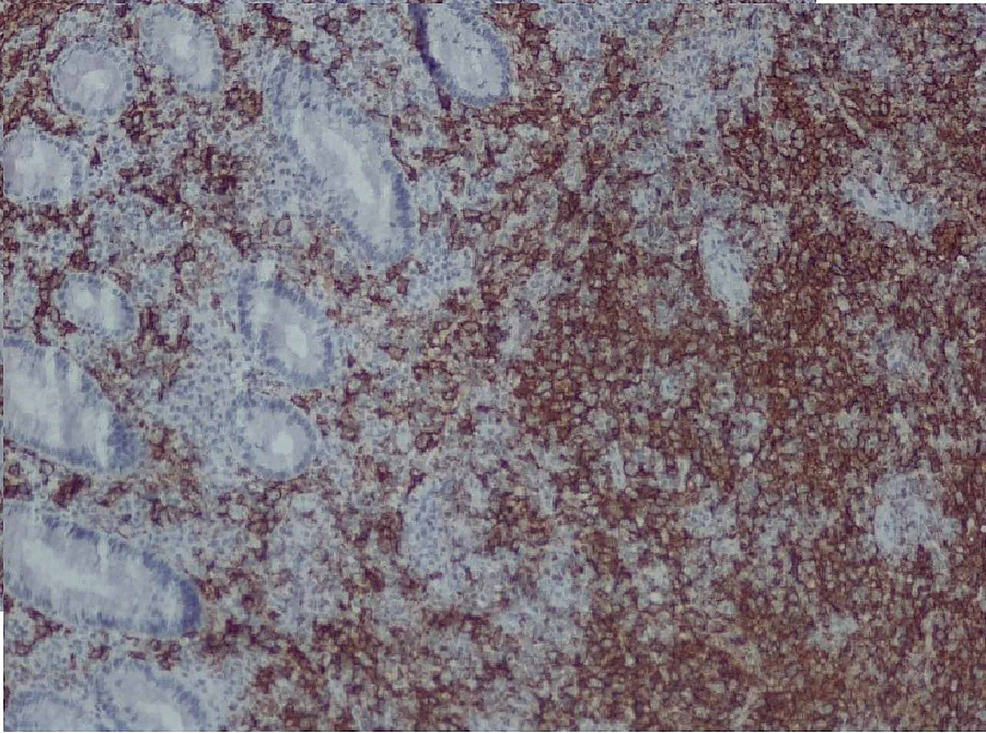 CD-20-stain-for-our-patient's-primary-DLBCL-of-the-colon