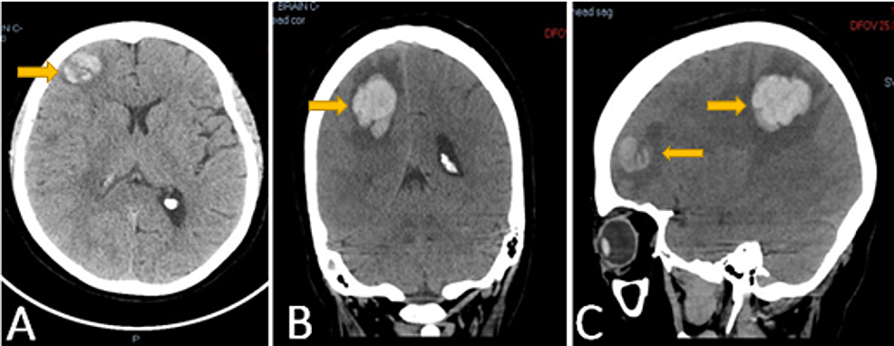 Cureus | A Fatal Case of Large Cell Neuroendocrine Lung ...