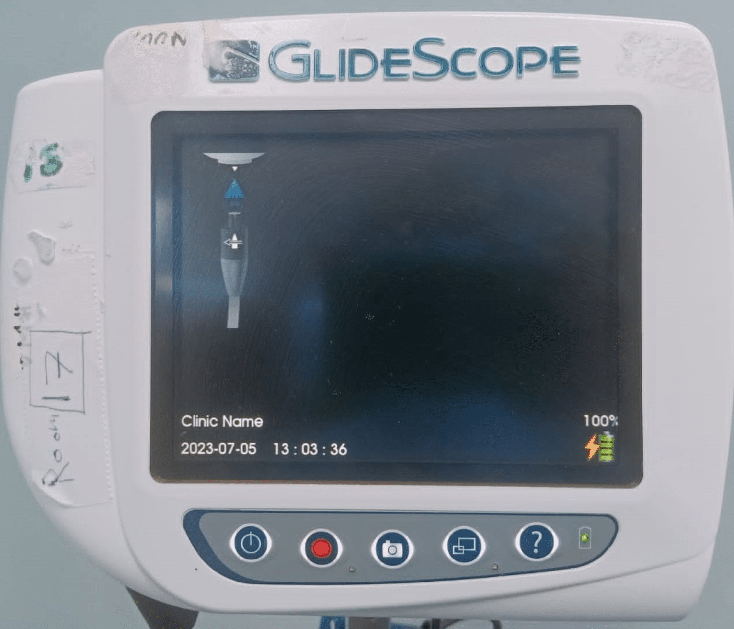 Tonsillar Trauma During Video Laryngoscopy A Case Report Cureus