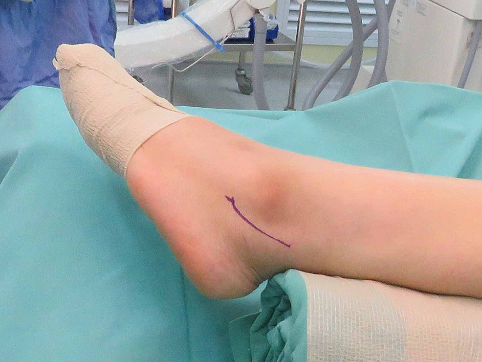 Lateral Ankle Ligament Reconstruction Technique