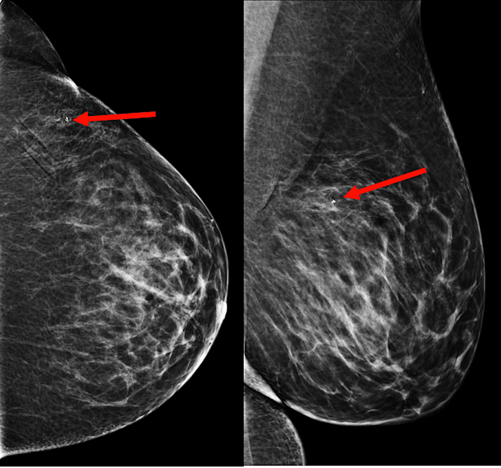 Protuberans Presenting as a Primary Breast Mass Cureus