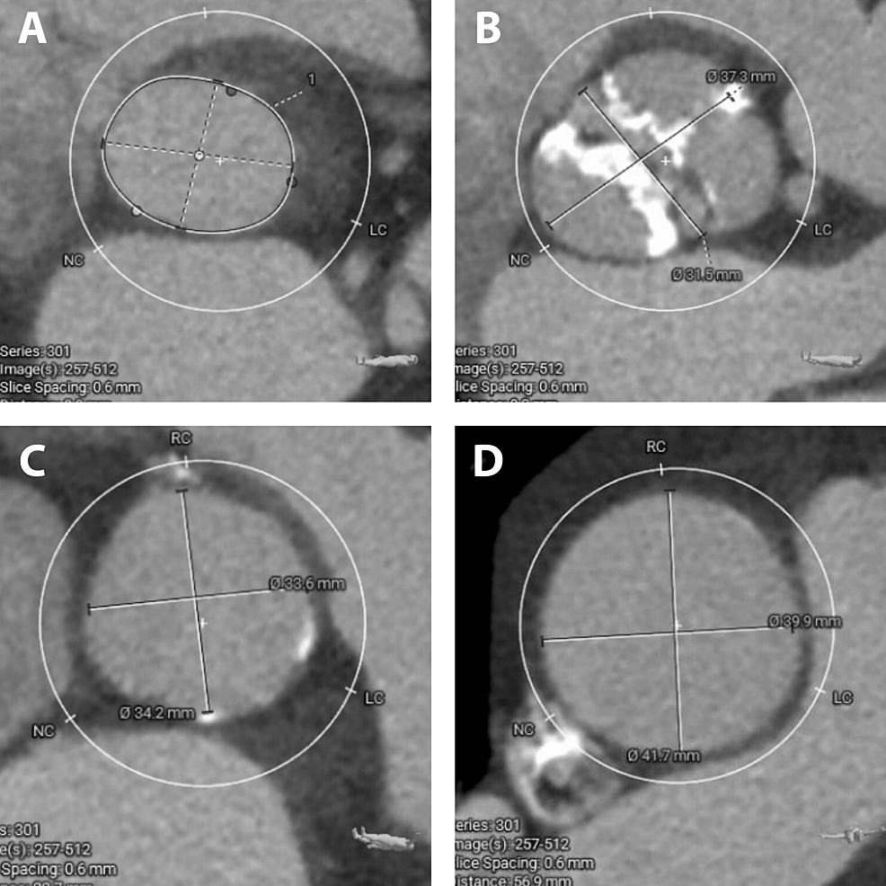 Cureus Successful Transcatheter Aortic Valve Replacement in an
