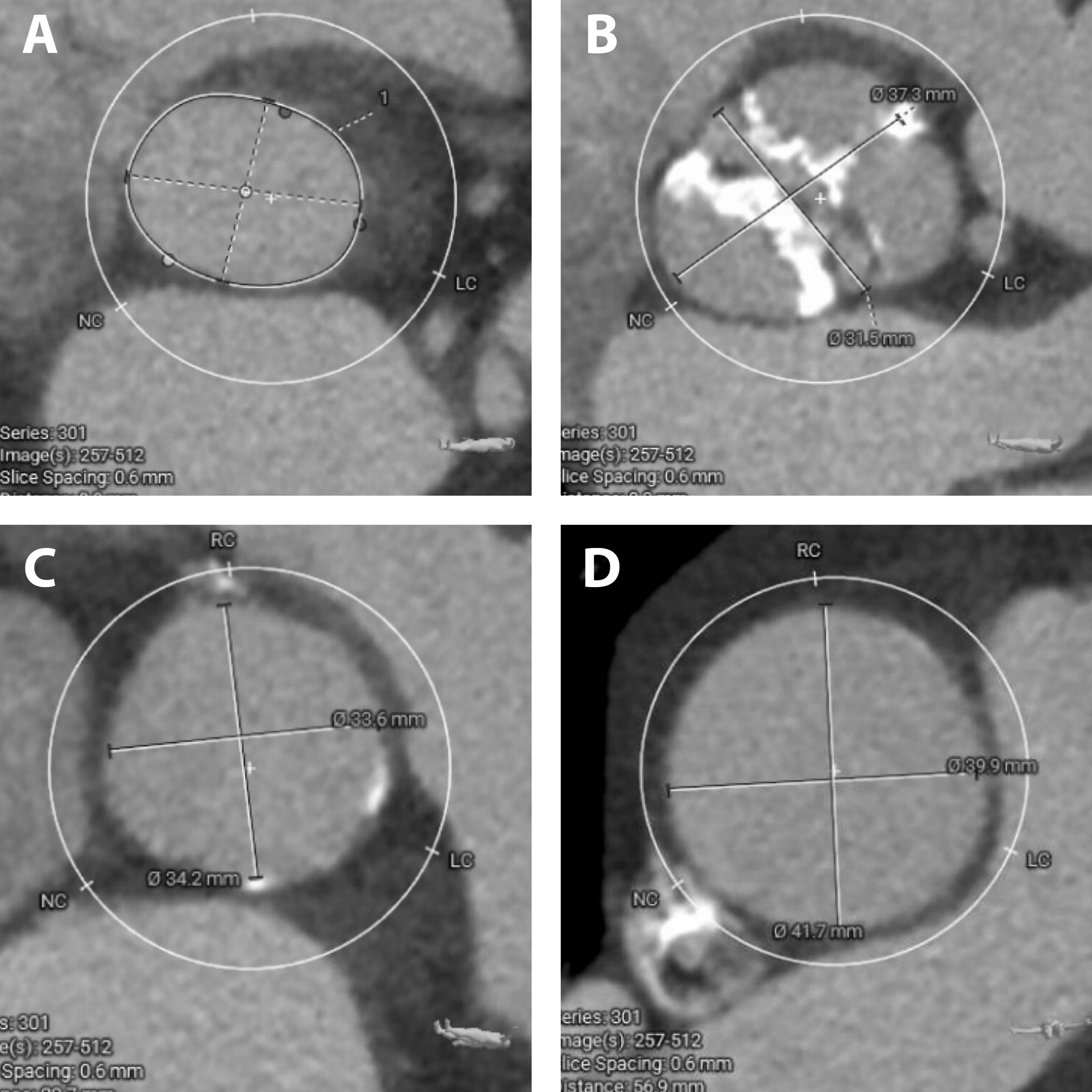 Cureus | Successful Transcatheter Aortic Valve Replacement In An ...