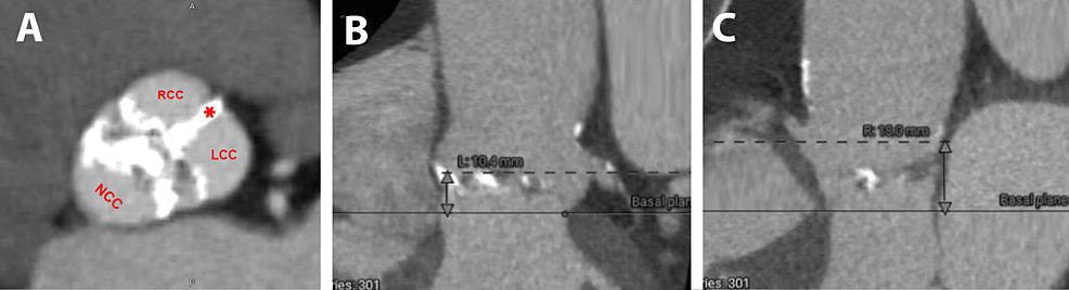 cureus-successful-transcatheter-aortic-valve-replacement-in-an