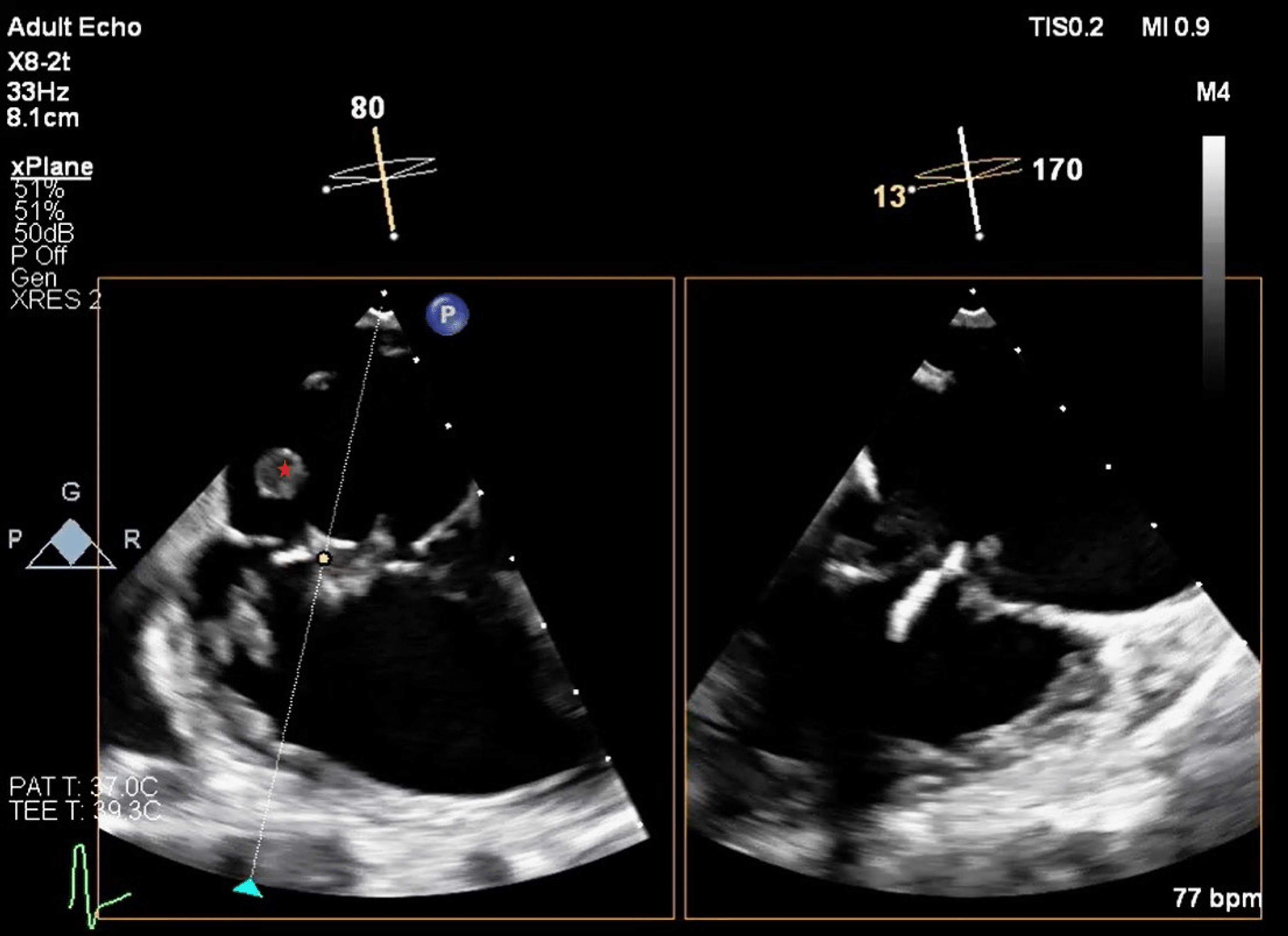 Cureus | Tumor in Transit: Intracardiac Leiomyomatosis