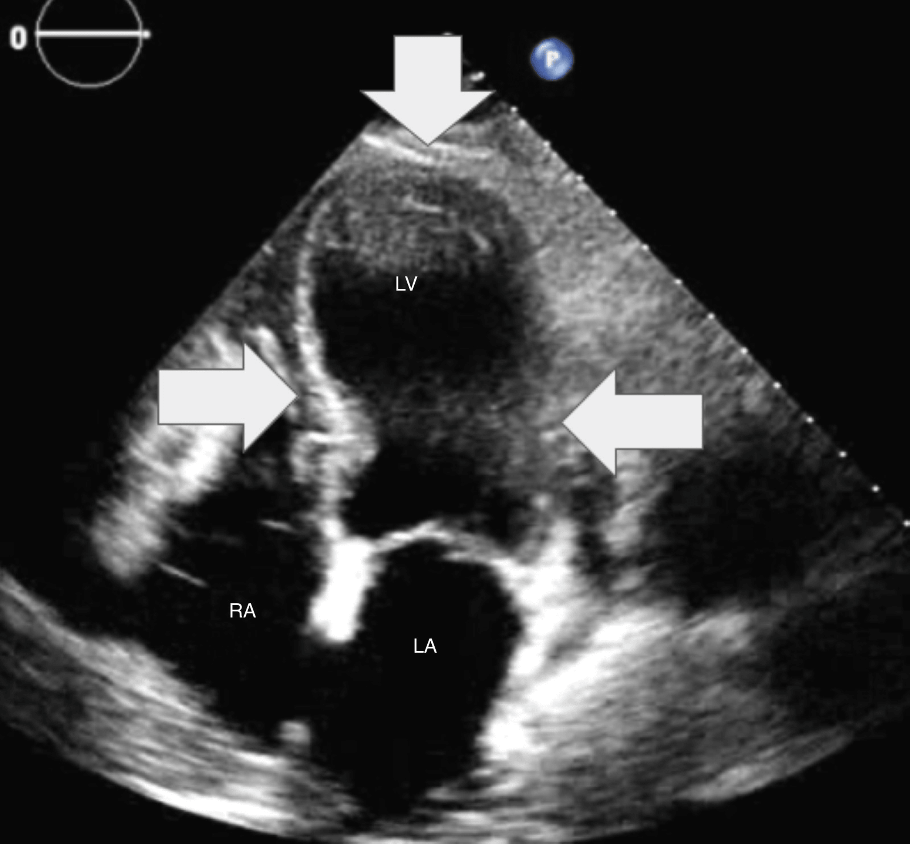 Cureus Takotsubo Cardiomyopathy Associated with Acute COVID19 Pneumonia