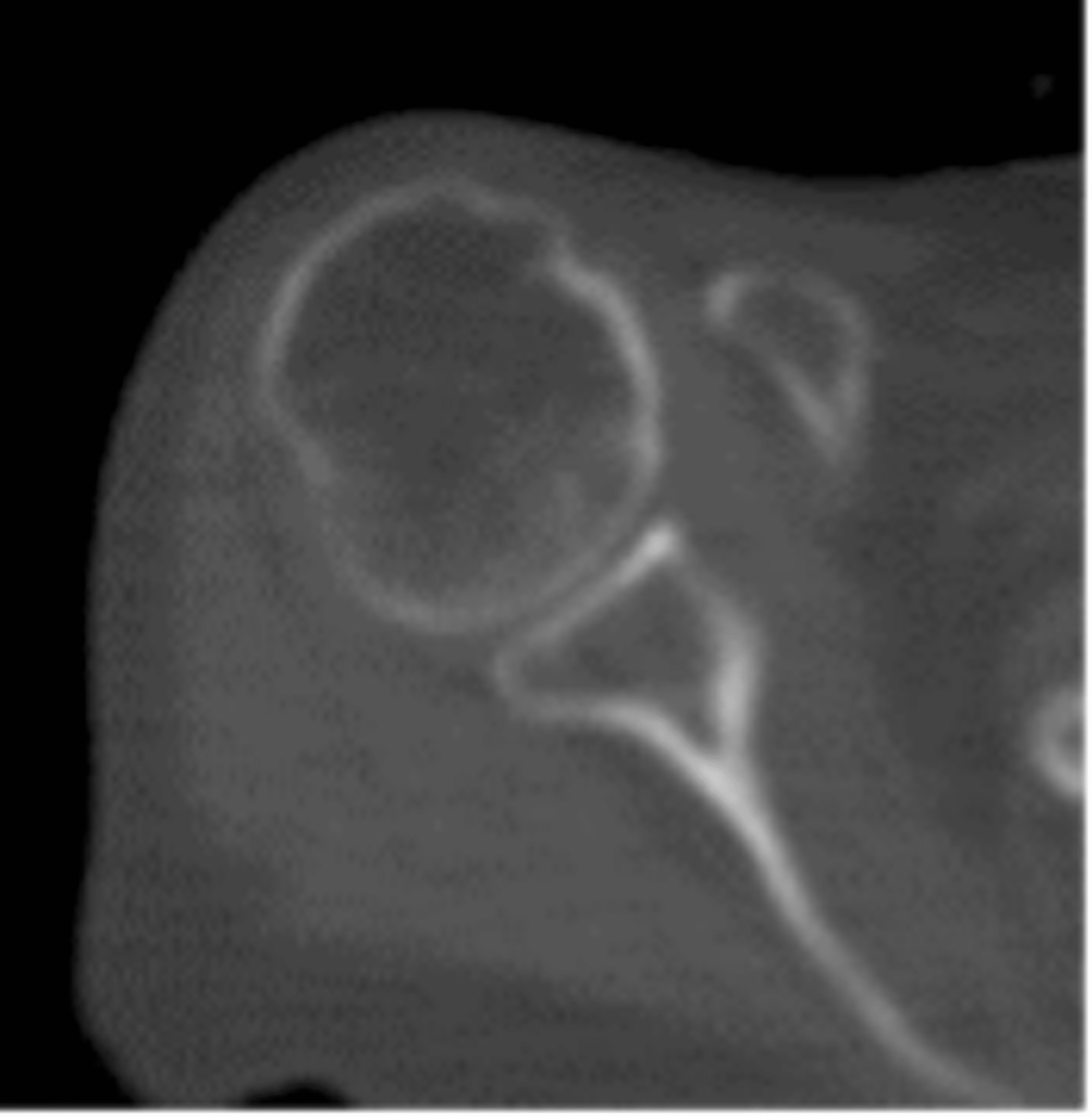 Cureus VoriconazoleInduced Periostitis A Case Report