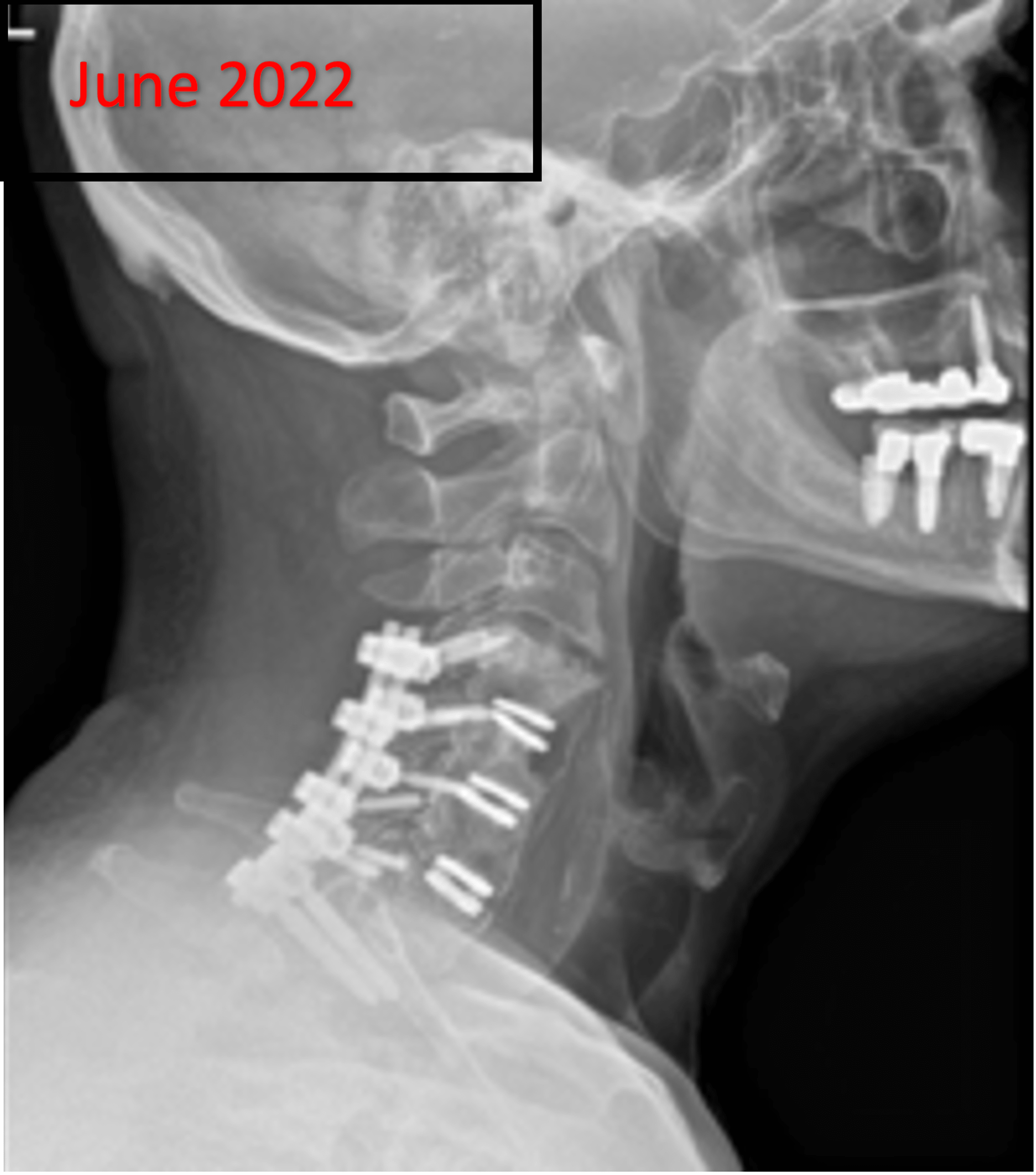 Cureus LongTerm Complication of ThreeLevel Cervical Artificial