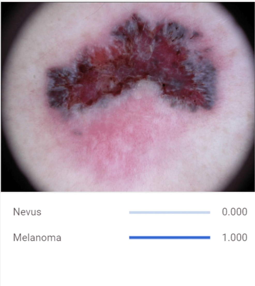 Utilizarea învățării automate pentru detectarea și diagnosticarea precisă a melanoamelor și nevi: un studiu multidisciplinar în dermatologie