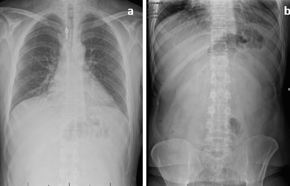 Acute Abdomen Is a Rare Presentation of COVID-19 in the Absence of Respiratory Manifestations: A Case Report - Cureus