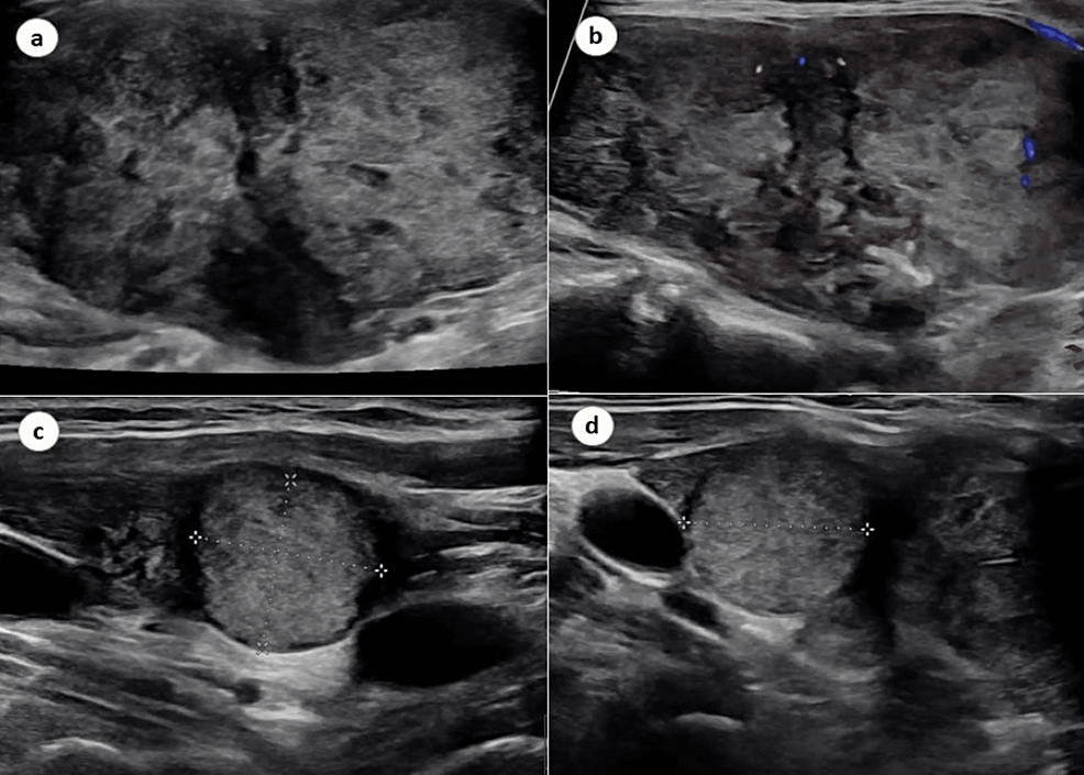 Cureus, A Comprehensive Management of Neck Hematoma in Post-Thyroidectomy  Patient for Papillary Thyroid Cancer: A Case Report