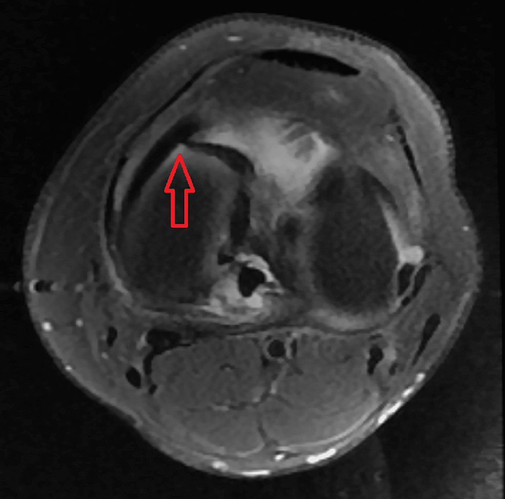 Cureus MRI in the Diagnosis of Bucket Handle Tears What Is the
