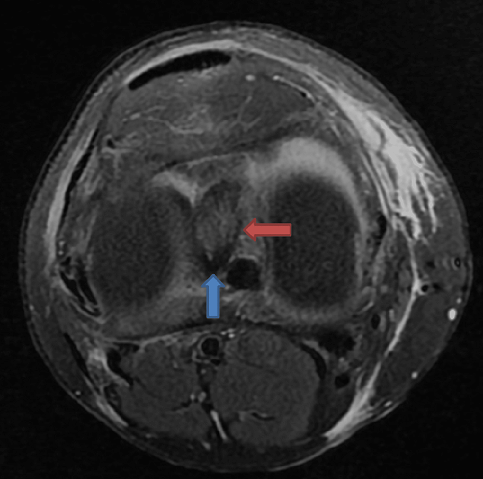 Cureus MRI in the Diagnosis of Bucket Handle Tears What Is the