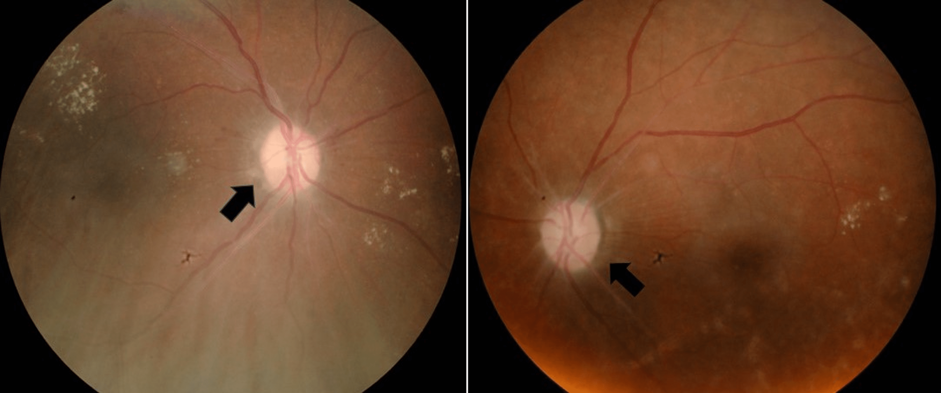 Cureus | Binasal Field Defect in Non-arteritic Anterior Ischemic Optic ...