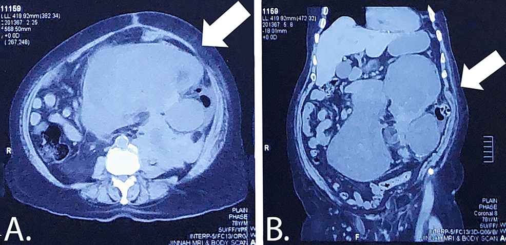 Cureus, Recurrent Retroperitoneal Spindle Cell Sarcoma: A Challenging Case  Report and Management Considerations