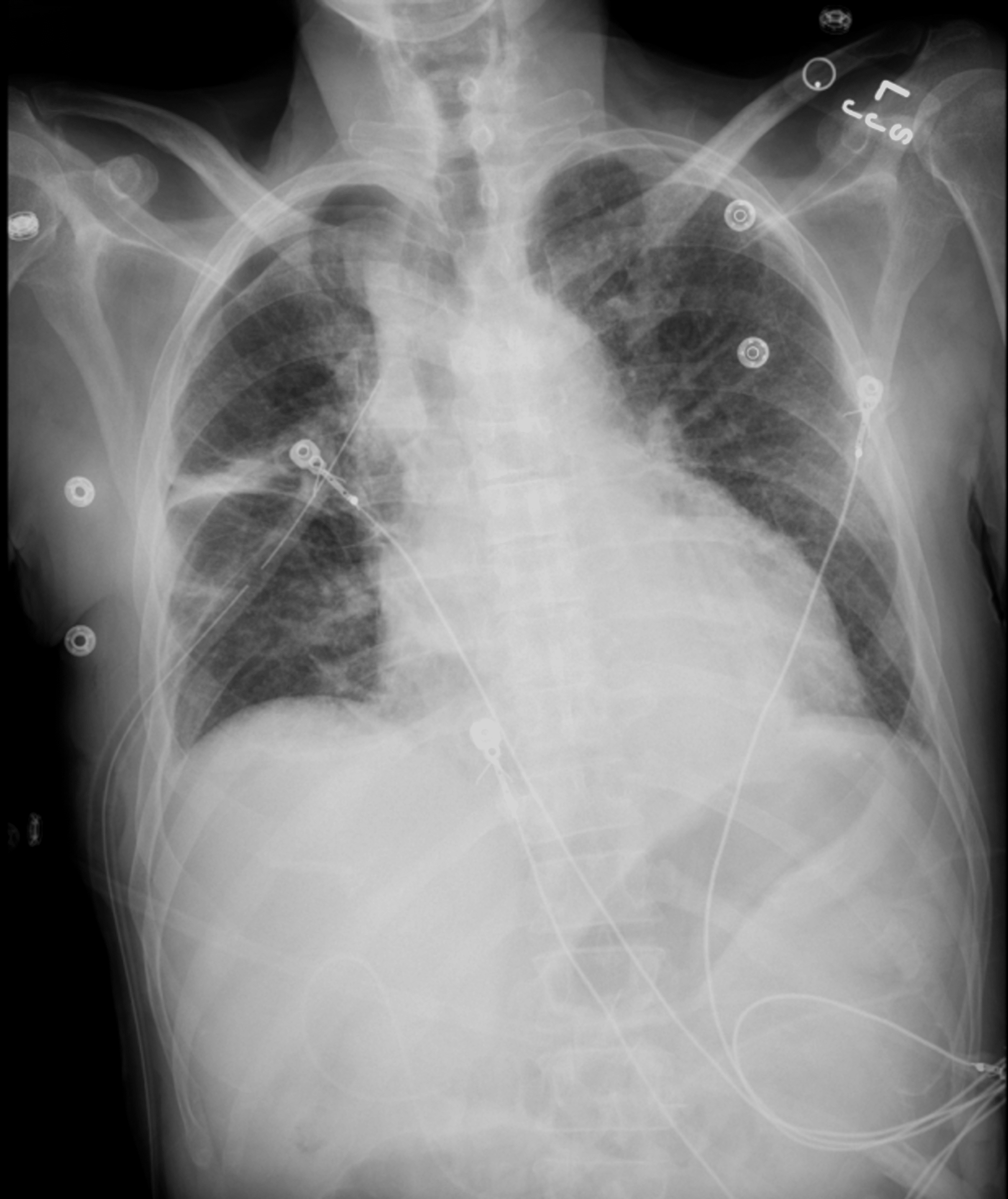 A Unique Case of Chylothorax Occurring PostChest Tube Insertion Cureus