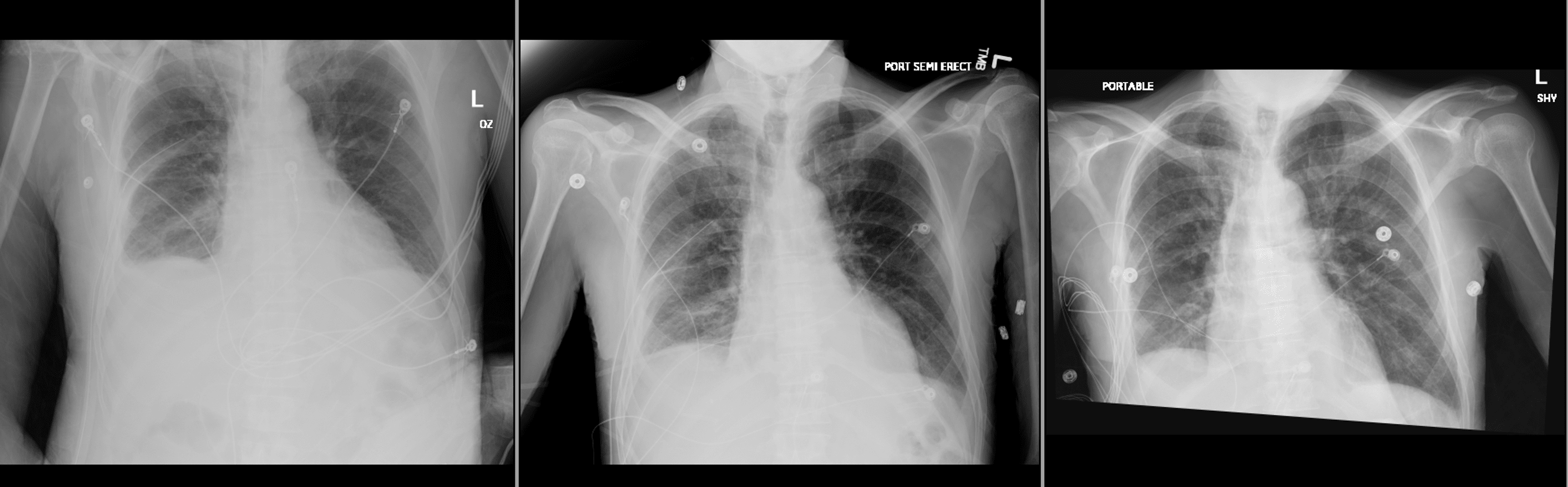 Cureus A Unique Case of Chylothorax Occurring PostChest Tube Insertion