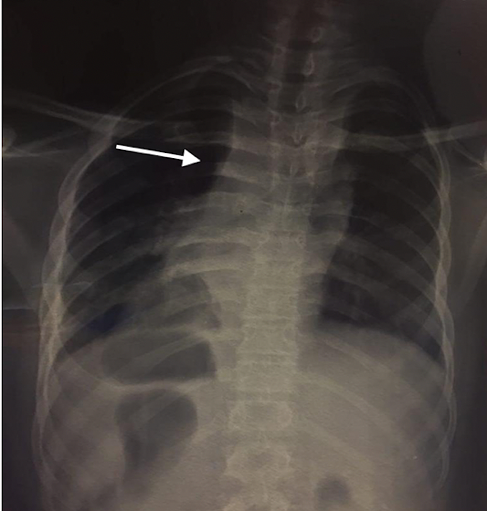 Chest-X-ray