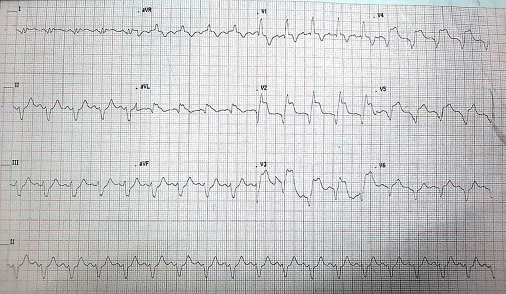 Cureus | A Case Report of High-Risk Percutaneous Coronary Intervention ...