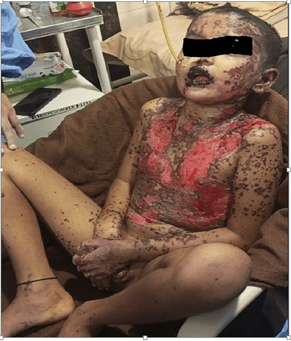 glutathione steven johnson syndrome Stevens-Johnson Syndrome Induced by Herbal Kadha