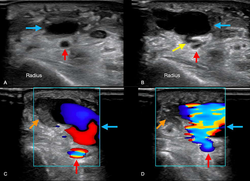 Ultrasonograficzna ocena pooperacyjnej rzekomo-tętniczej choroby naczyniowej: techniki, implikacje kliniczne i integracja oddziału ratunkowego