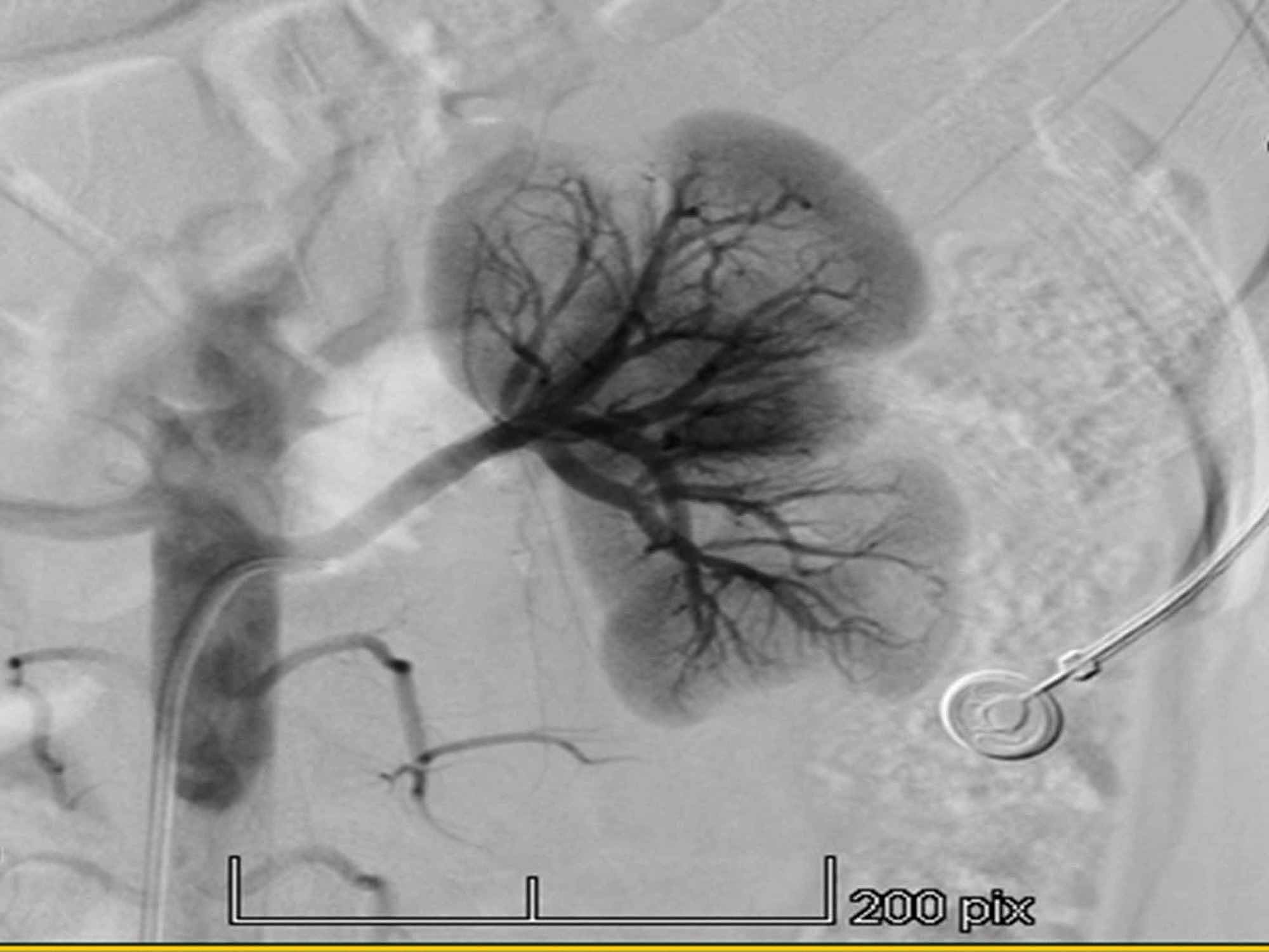 Cureus Nutcracker Syndrome with Hypertension A Case Report