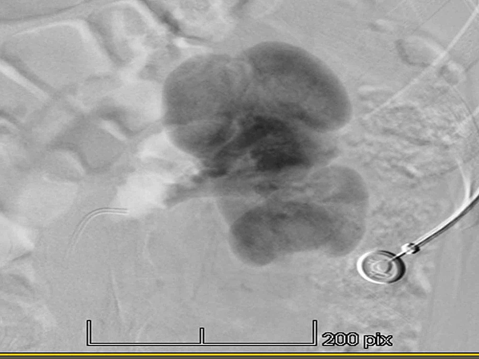 Cureus Nutcracker Syndrome with Hypertension A Case Report