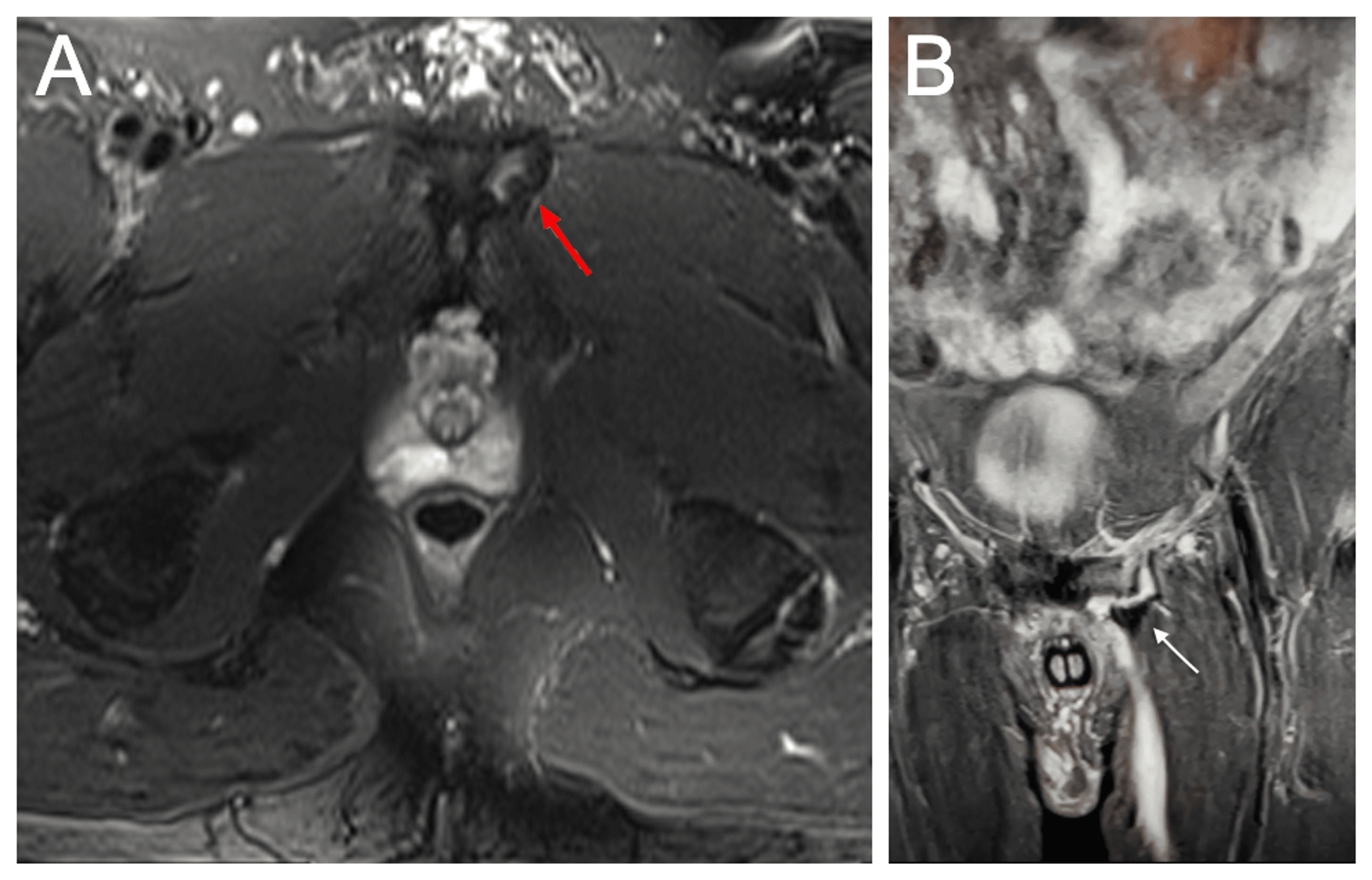 Cureus Sports Hernias A Comprehensive Review for Clinicians
