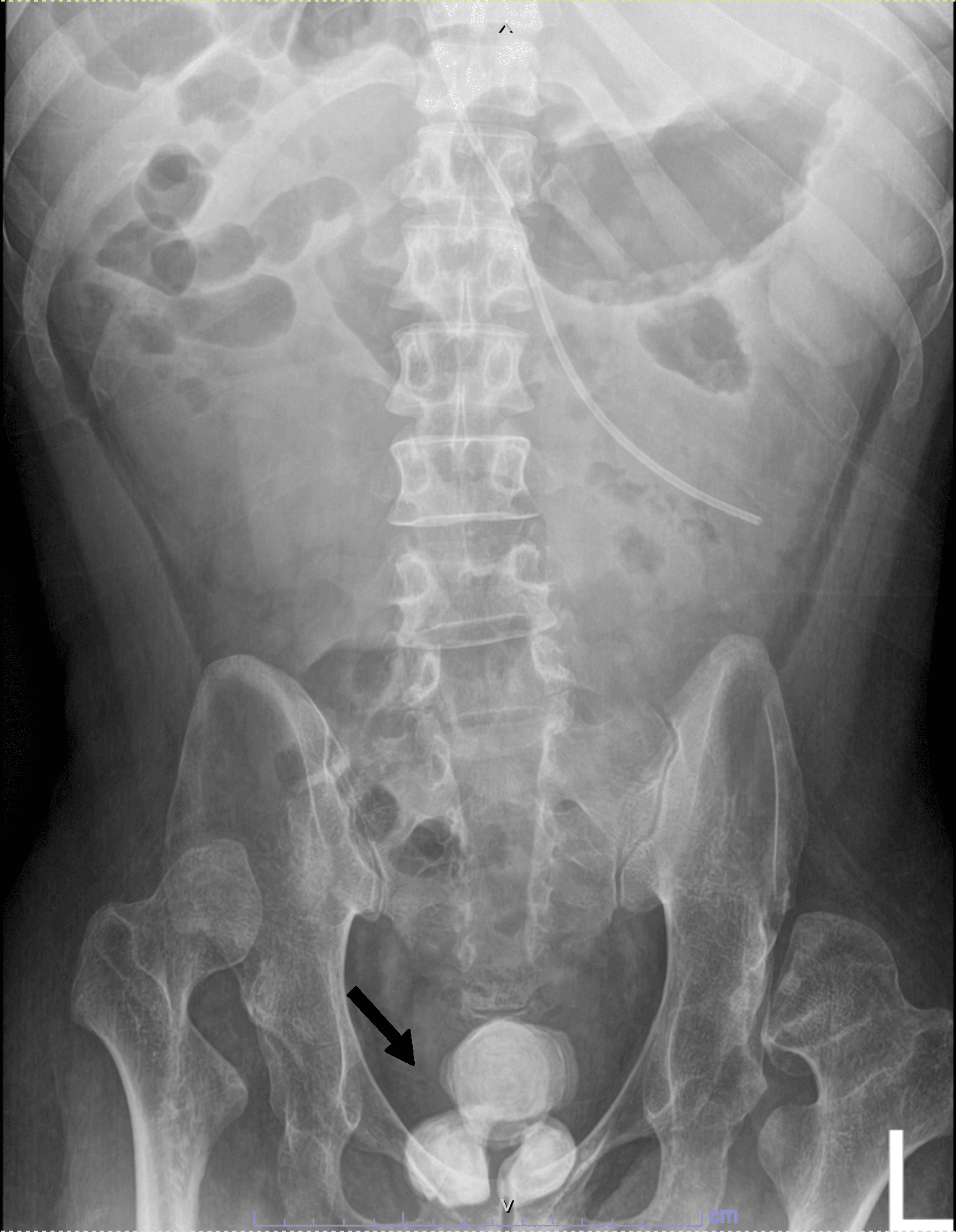 Cureus Giant Prostatic Stones and a Massive Bladder Stone Leading to