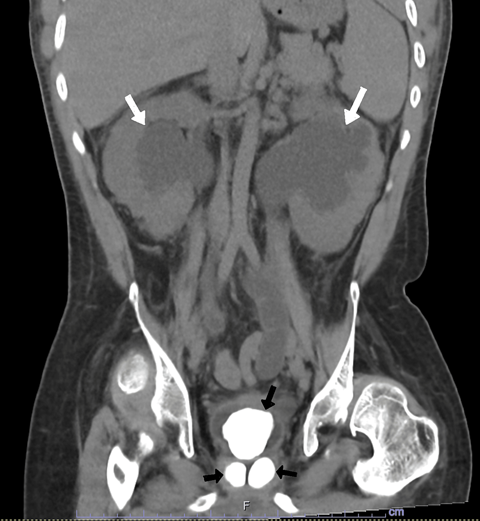 Cureus Giant Prostatic Stones and a Massive Bladder Stone Leading to