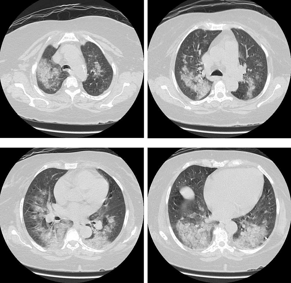 Cureus | Lenalidomide-Induced Diffuse Alveolar Hemorrhage In Patient ...