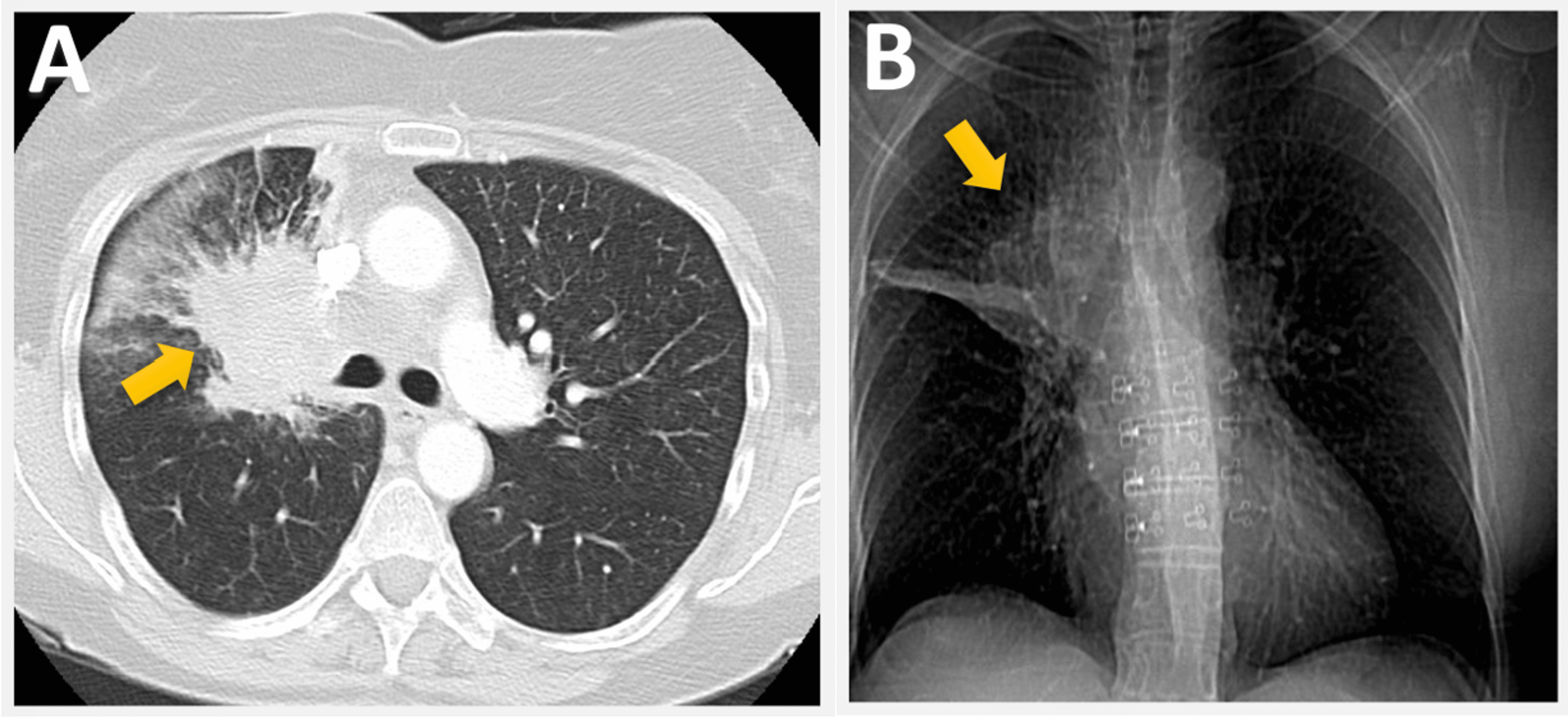 Cureus RadiationAssociated as a Presentation of Disease