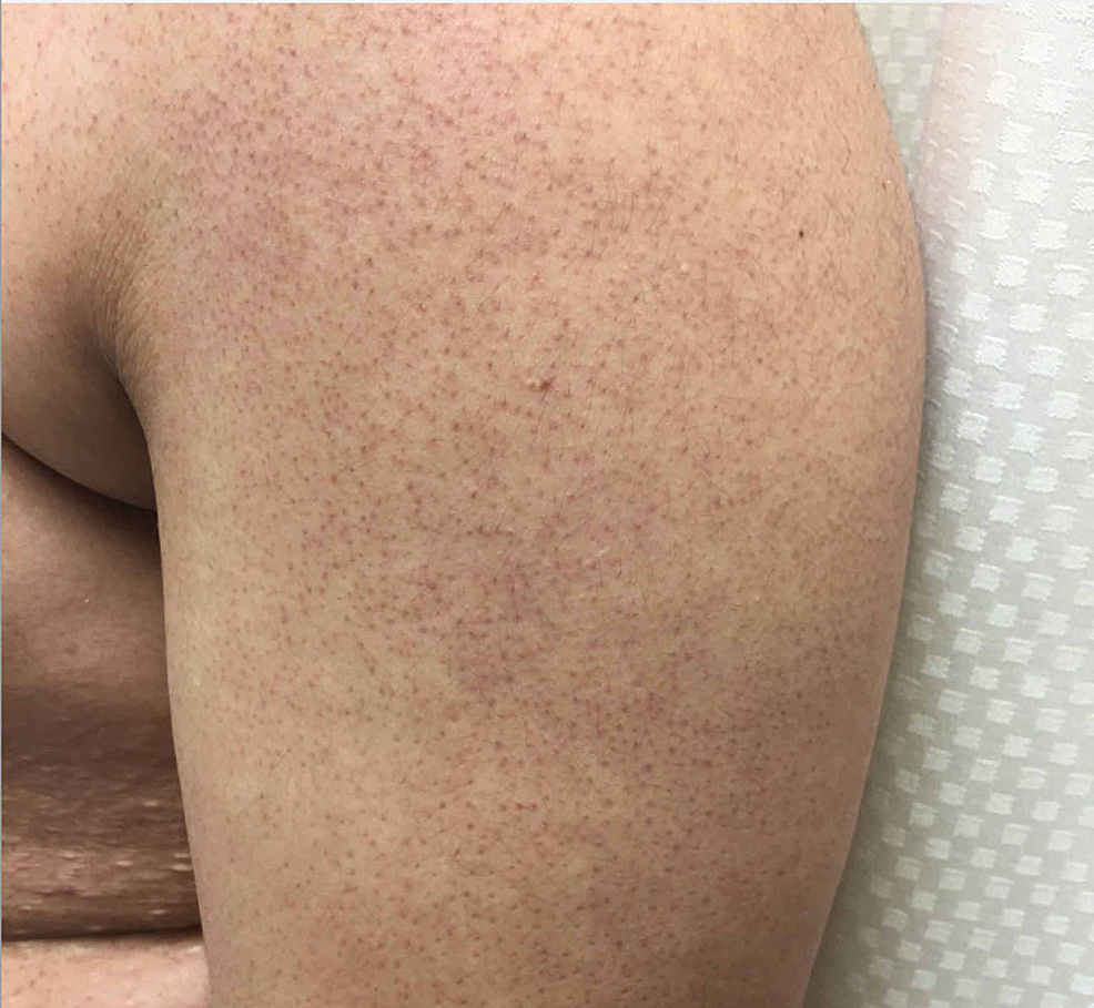 Cureus | Hidradenitis Suppurativa in a Patient with Smith-Magenis