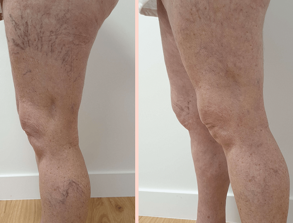 Endovenous Laser AblationPhlebectomySclerotherapy Hybrid Treatment for Venous Insufficiency A