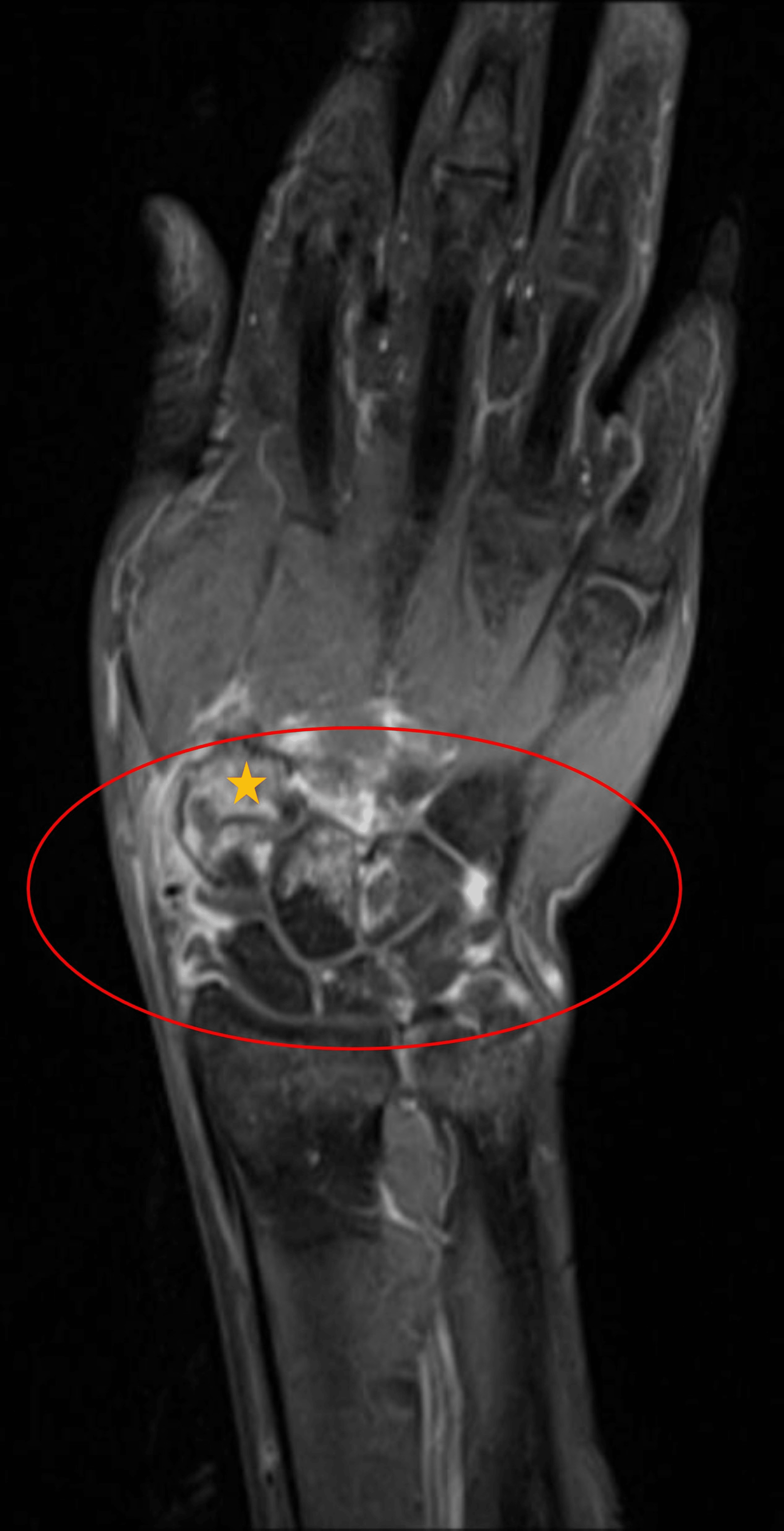 Cureus Aspergillus fumigatus Septic Arthritis of the Wrist A Report