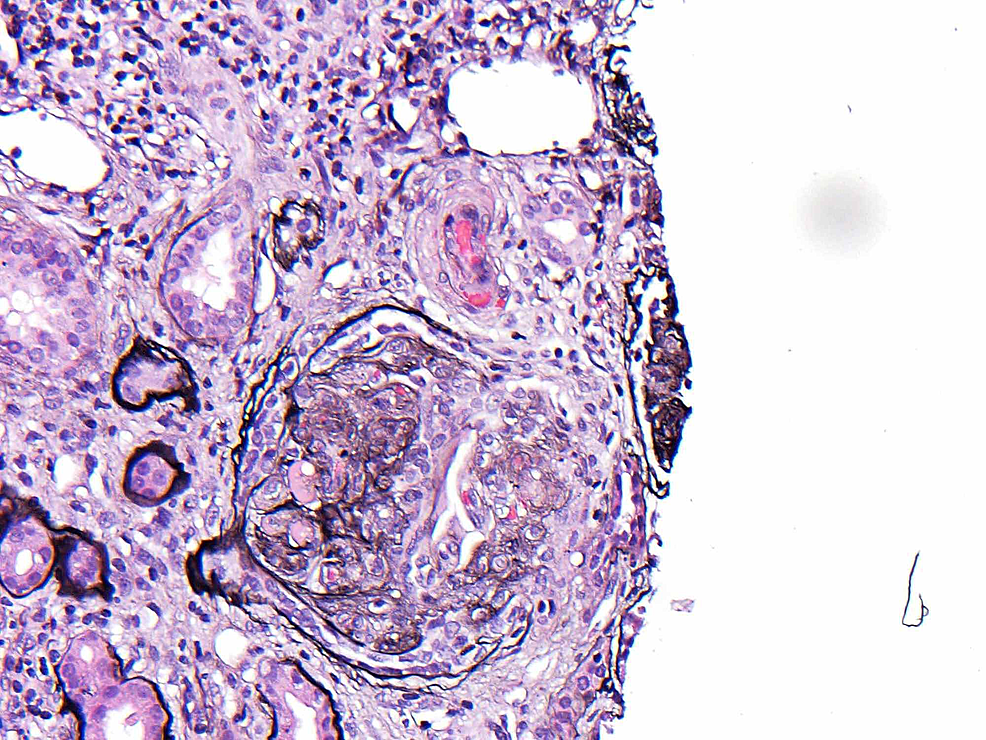 Light-microscopy-shows-glomerular-sclerosis